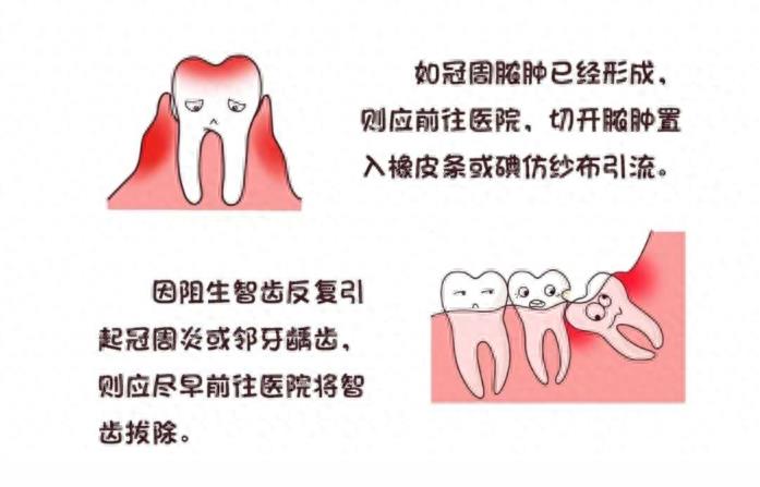 口腔常识手册之智齿，一组图带你了解智齿为什么疼