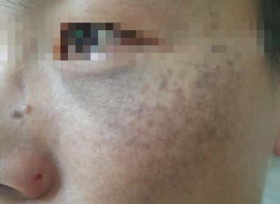 ​你知道孩子的胎记是哪种吗？这5种常见的胎记快来对照一下吧