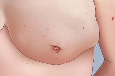 乳腺癌早期症状图片