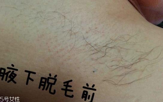 雅萌脱毛仪闪灯次数是多少 雅萌脱毛仪的使用寿命 雅萌脱毛仪闪灯次数是多少 雅萌脱毛仪的使用寿命