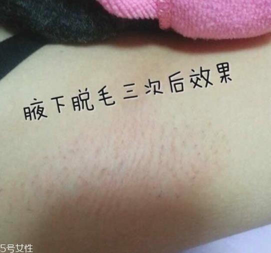 雅萌脱毛仪闪灯次数是多少 雅萌脱毛仪的使用寿命 雅萌脱毛仪闪灯次数是多少 雅萌脱毛仪的使用寿命