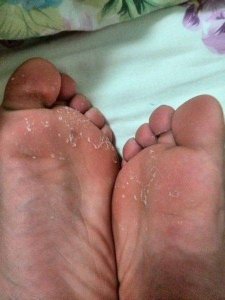 ​脚脱皮的治疗 脚脱皮用什么药治最好