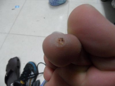 ​肉刺是什么（什么是肉刺）