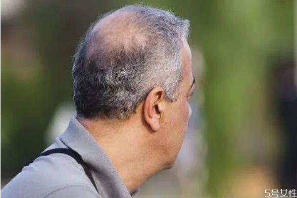 男生脱发的原因是什么 什么会导致脱发男生 男生脱发的原因是什么 什么会导致脱发男生