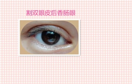 这些都是割双眼皮失败案例图片，看完你还敢割双眼皮吗？