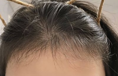 ​掉发应该怎么办? 掉发如何挽救