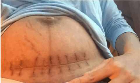 4年剖3胎，老婆真的不疼？剖过的女人：终于不用生了！